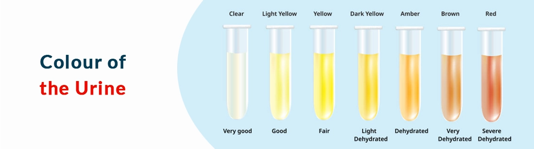Prone to an Abnormal Urine Colour